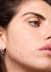 is-there-a-relationship-between-dairy-products-and-acne
