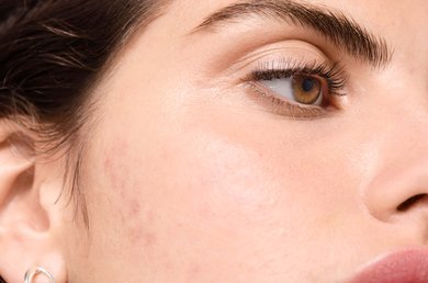 is-there-a-relationship-between-dairy-products-and-acne