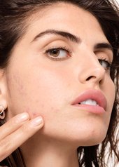 what-is-hormonal-acne-and-how-can-a-skincare-routine-help