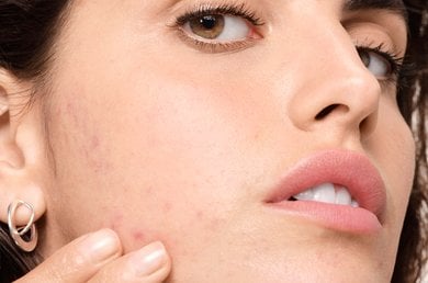 what-is-hormonal-acne-and-how-can-a-skincare-routine-help